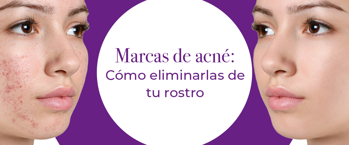 Marcas de acné: cómo eliminarlas de tu rostro