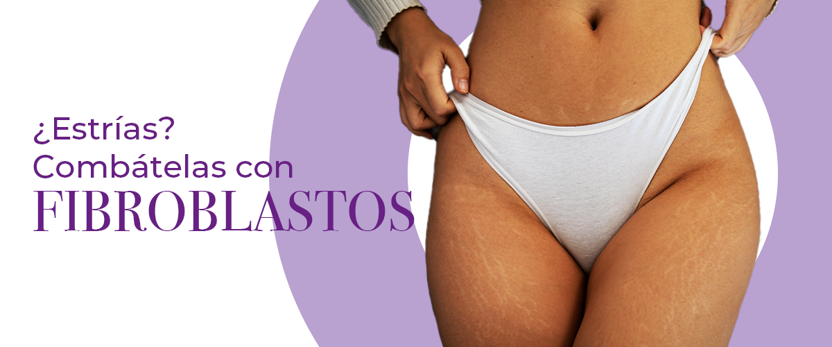 ¿Estrías? Combátelas con fibroblastos